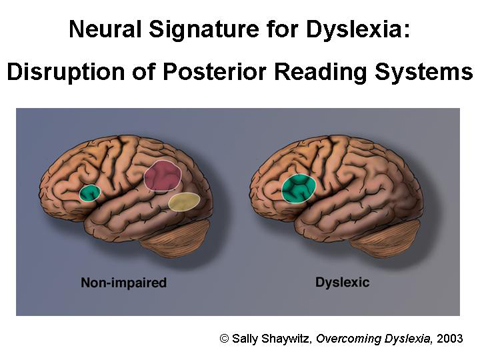 Dyslexia Brain image